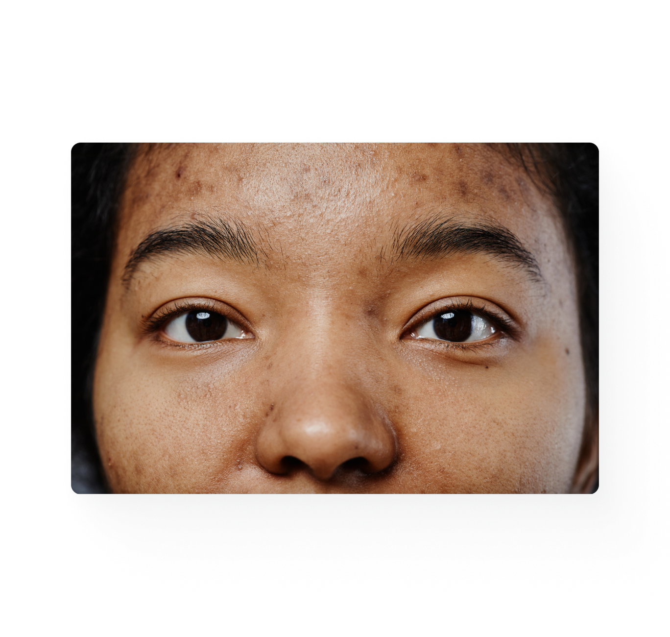 Close-up image of a woman with acne.