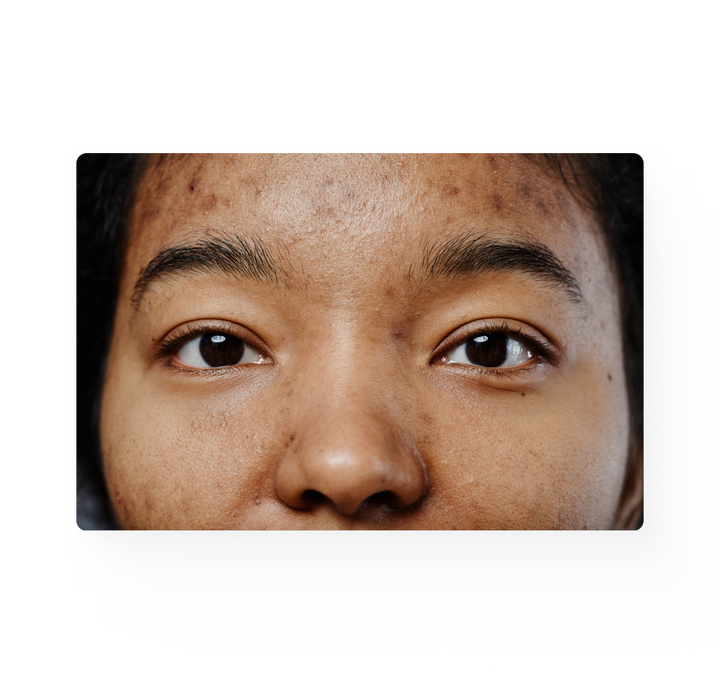 Close-up image of a woman with acne.